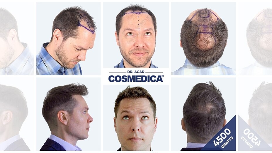 Haartransplantation Istanbul: Eines von vielen überzeugenden Vorher-Nachher-Ergebnissen von Cosmedica