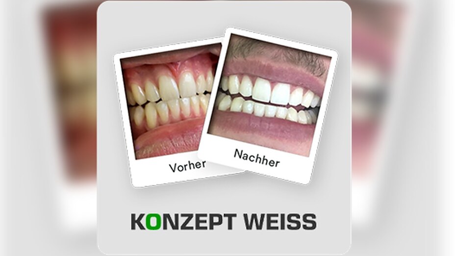 Vorher-Nachher-Vergleich einer Zahnaufhellung Vorher-Nachher-Vergleich einer Zahnaufhellung