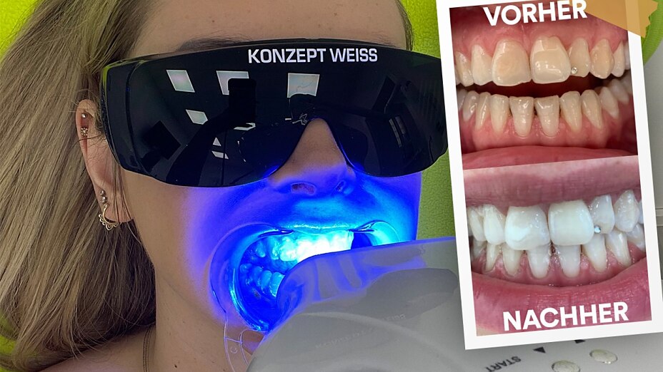 Vorher-Nachher Vergleich Zahnaufhellung