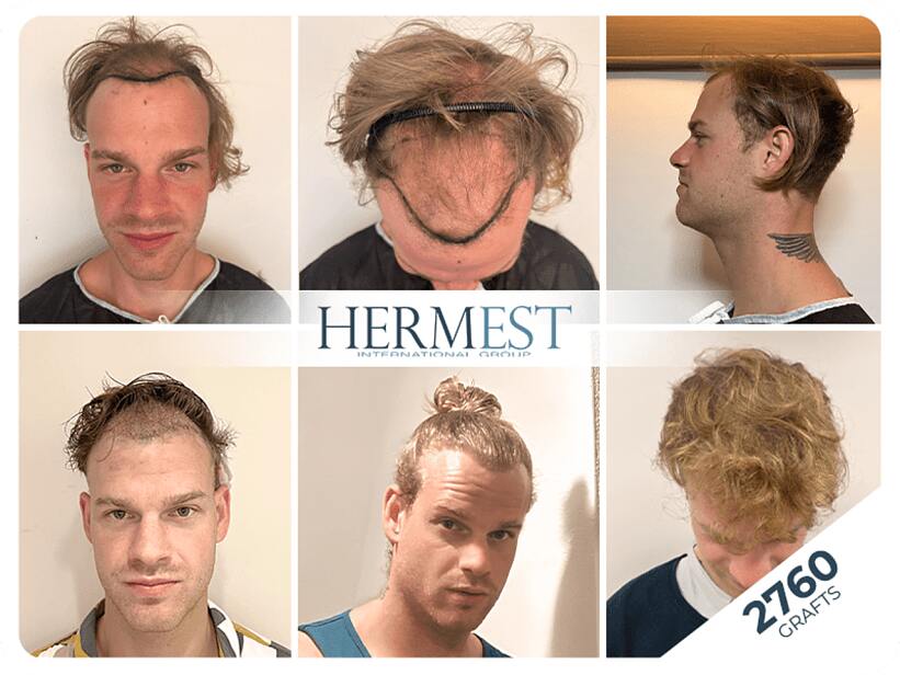Beeindruckendes Vorher-Nachher-Ergebnis nach Haartransplantation bei der Hermest Clinic – natürlich und dicht! Beeindruckendes Vorher-Nachher-Ergebnis nach Haartransplantation bei der Hermest Clinic – natürlich und dicht!