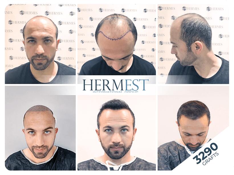 Verblüffende Transformation: Vorher-Nachher-Ergebnis einer Haartransplantation bei der Hermest Clinic. Verblüffende Transformation: Vorher-Nachher-Ergebnis einer Haartransplantation bei der Hermest Clinic.
